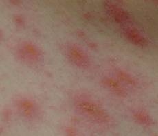 粃 と 糠 は 🐲ジベル 薔薇色 妊婦の「かゆくない湿疹」は梅毒やジベルばら色粃糠疹かも。対処法は？
