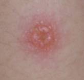 糠 ジベル ばら色 原因 粃 疹 ジベルバラ色粃糠疹について