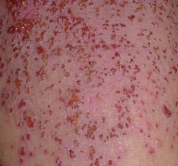 発疹 再発 症 様 水痘 カポジ 日本臨床皮膚科医会